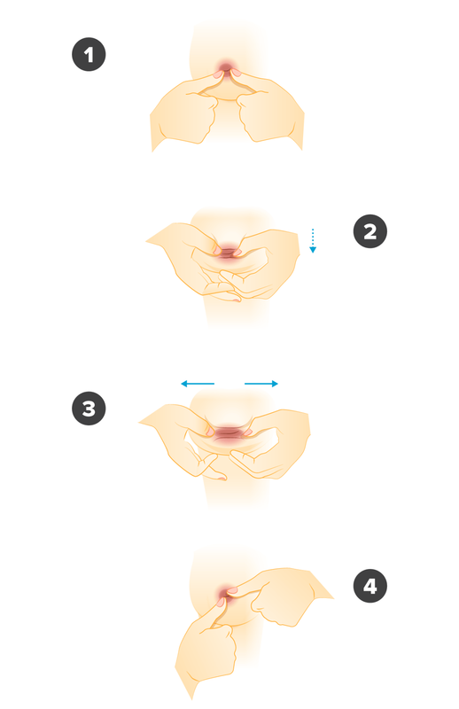 Inverted Nipple Treatment: What Works?
